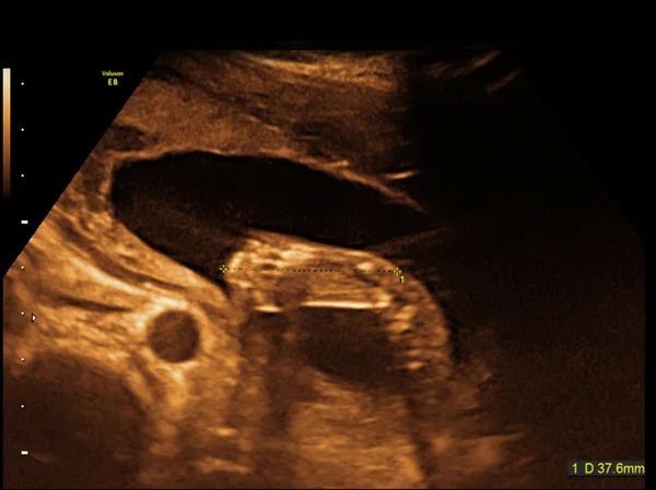 Bebé en la imagen de ultrasonido — Foto de Stock