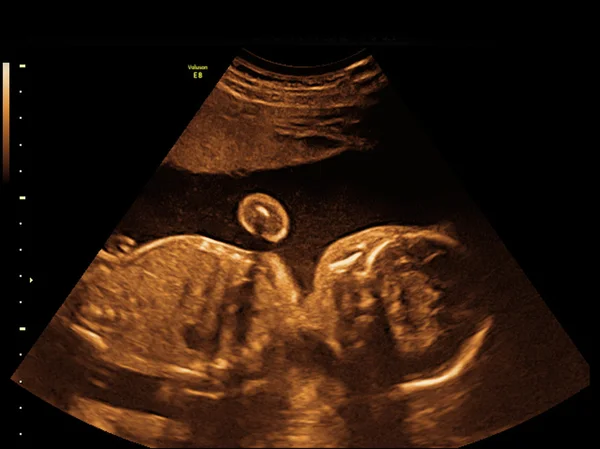 Baby op de echografie afbeelding — Stockfoto