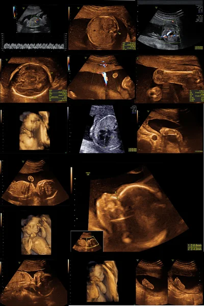 Baby on the ultrasound image — Stock Photo, Image