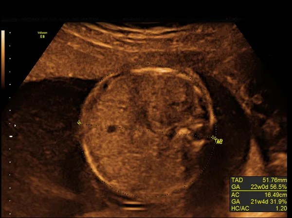 Baby on the ultrasound image — Stock Photo, Image