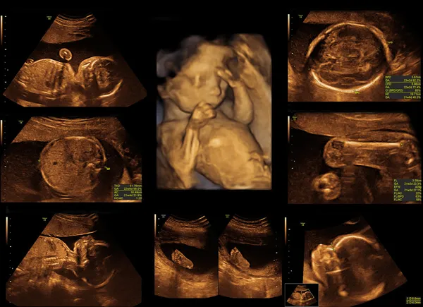 Μωρό στην υπερηχογραφική εικόνα — Φωτογραφία Αρχείου