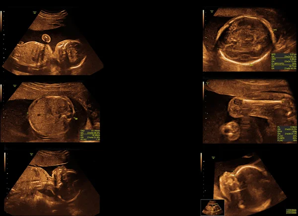 Baby op de echografie afbeelding — Stockfoto