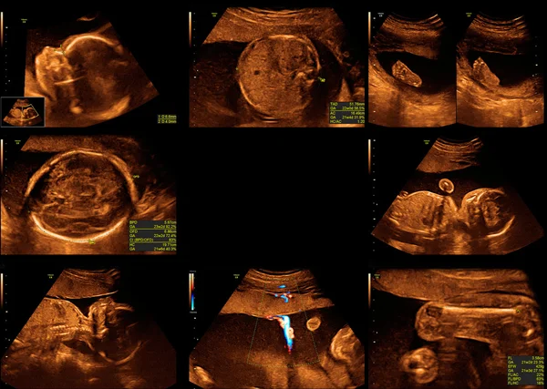 Baby on the ultrasound image — Stock Photo, Image