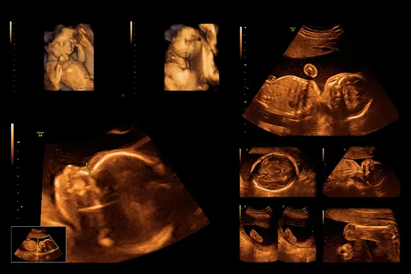 Child in the picture ultrasound — Stock Photo, Image