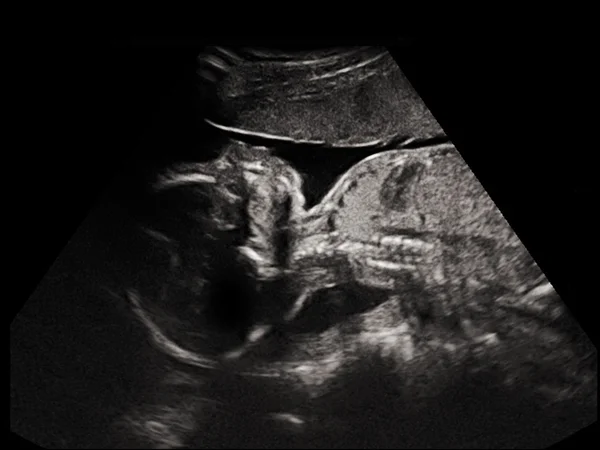 Niño en la imagen ultrasonido — Foto de Stock