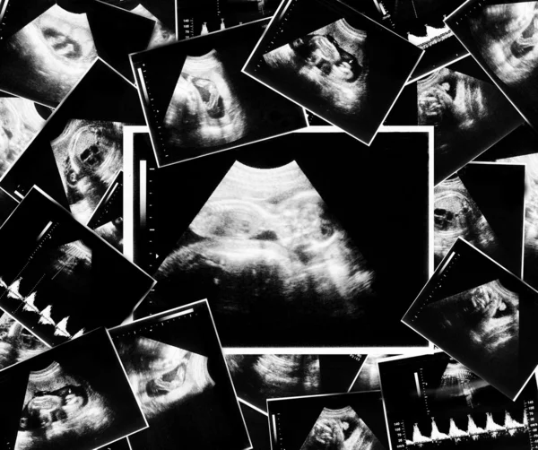 Un bambino nella foto ultrasuoni — Foto Stock