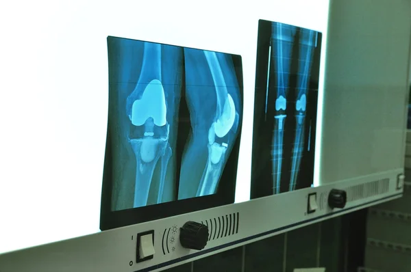 Prothèse de genou à rayons X Photos De Stock Libres De Droits
