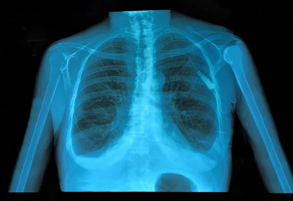 Xray lung — Stock Photo, Image