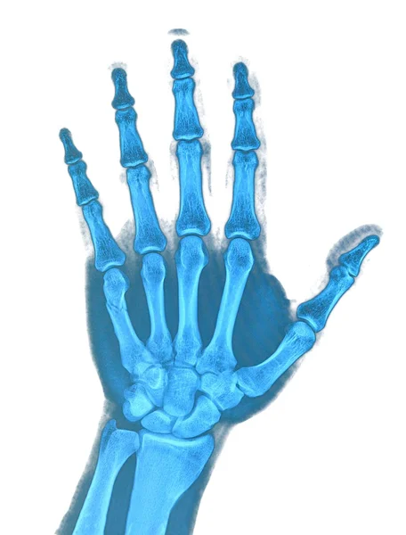 Hand x-ray — Stock Photo, Image