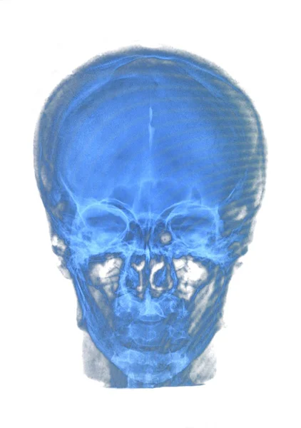 Human skull xray — Stockfoto