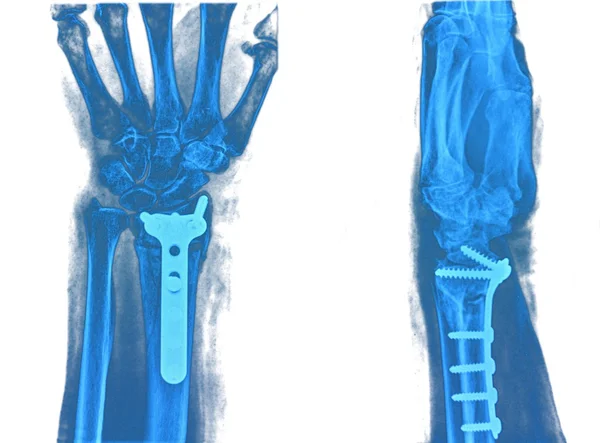 Röntgenbild der Hand — Stockfoto