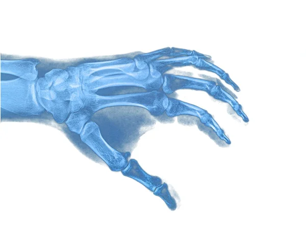 Hand x-ray — Stock Photo, Image