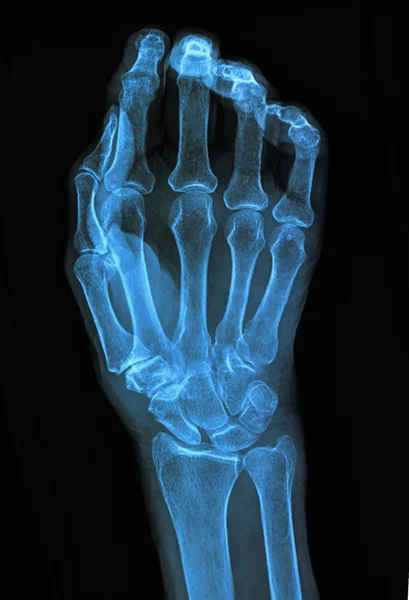 Rayos X de la mano — Foto de Stock