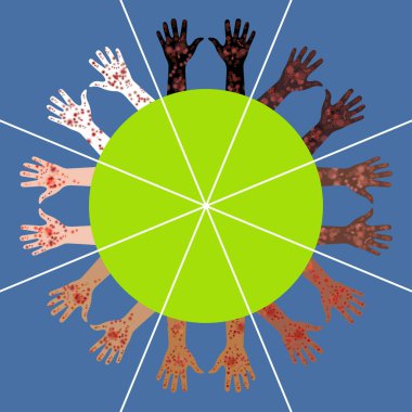 El çiftlerinin 8 farklı ten rengi. Avuçlar dairenin etrafında. Değişen pigmentasyonlarda acı verici bir kızarıklık. Cilt rengi ne olursa olsun deriyi etkiler. Irksal pigmentasyonlu deri hastalıkları.