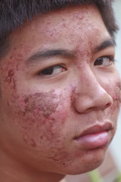 Male ace with acne problem skin — Stock Photo, Image