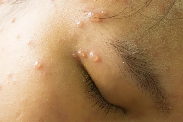 Chickenpox on face — Stock Photo, Image