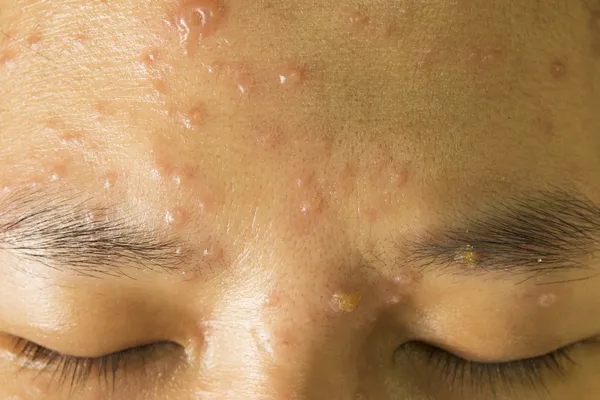 Chickenpox on face — Stock Photo, Image