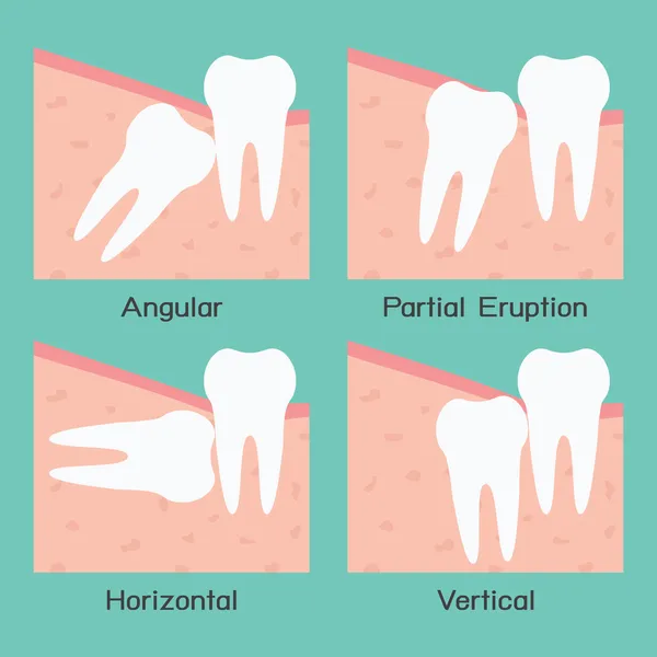 Wisdom Tooth — Stock Vector