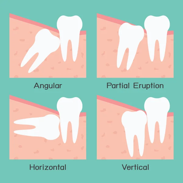 Зуб мудрости — стоковый вектор