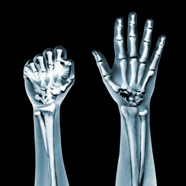 dramatize x ray iki siyah eller