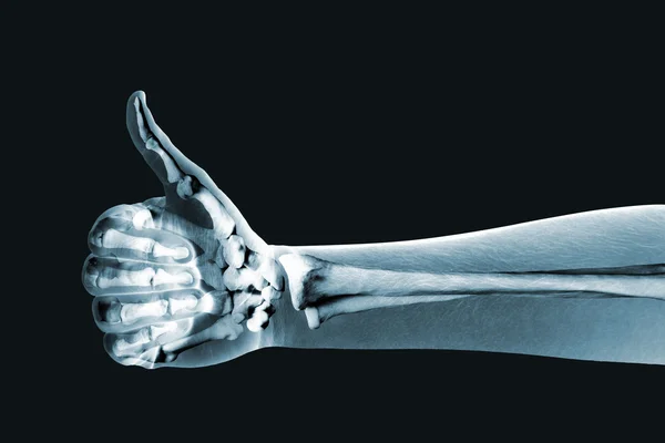 Драматизированный рентген большого пальца руки вверх Стоковое Фото