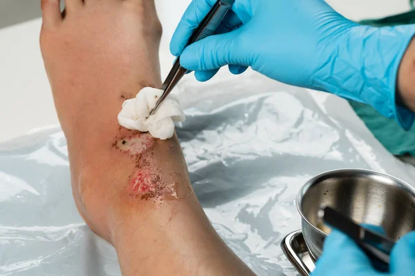 Крупним Планом Лікар Чистить Рану Нозі Травми Від Падіння — стокове фото