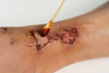 Doktor bacağındaki yarayı kapat, düşmekten yaralanma var. 