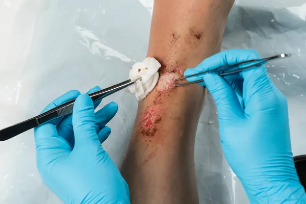 Крупним Планом Лікар Чистить Рану Нозі Травми Від Падіння — стокове фото