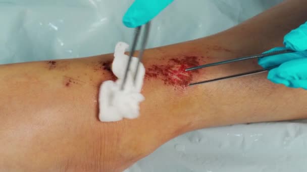 Doktorun Bacağındaki Yarayı Alkolle Kapatması Düşmekten Kaynaklanan Yaralanmalar — Stok video