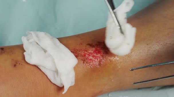 Κλείσιμο Γιατρός Καθαρισμού Πληγή Στο Πόδι Από Αλκοόλ Τραυματισμοί Από — Αρχείο Βίντεο