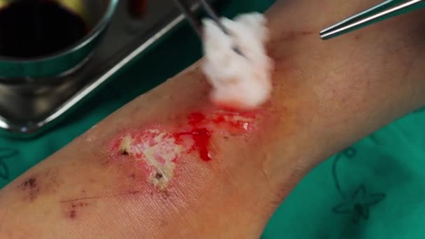 Крупним Планом Лікар Очищає Рану Нозі Від Алкоголю Травми Від — стокове відео