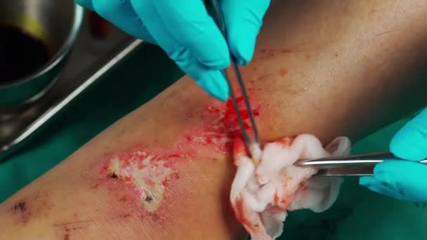 Nahaufnahme Arzt Reinigt Wunde Bein Durch Alkohol Verletzungen Durch Sturz — Stockvideo