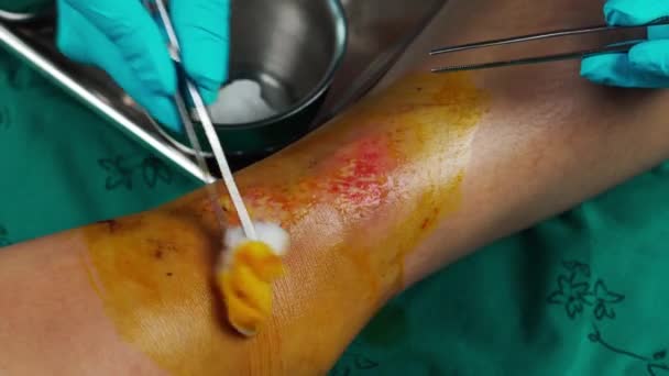 足の傷を治し転倒による負傷 — ストック動画