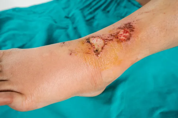 Bacağındaki Yara Düşmekten Kaynaklanan Yaralanmalar — Stok fotoğraf