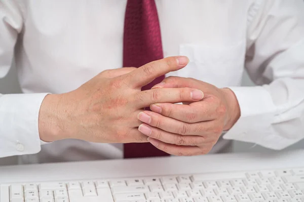 Hand of businessman suffering from finger joint pain. Causes of rheumatoid arthritis, gout. Health care and medical concept.