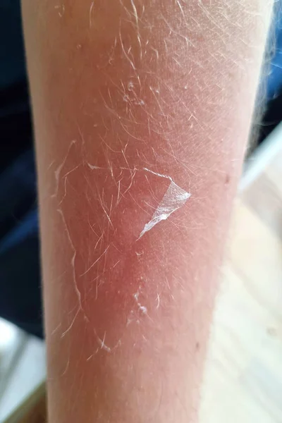Human Hand Skin Flaky Due Sunburn Peeling Skin — Stock Photo, Image