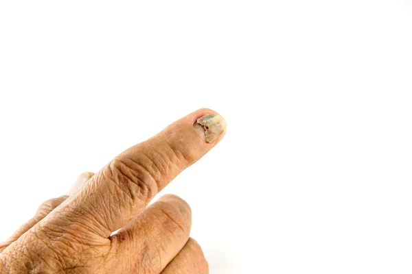Nagel detachement van oude vrouw vinger — Stockfoto