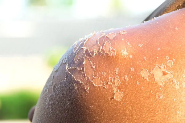 Peeling Sunburned Back — Stock Photo, Image