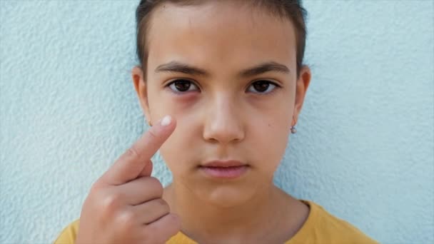 Child Eye Inflamed Selective Focus Kid — Vídeos de Stock