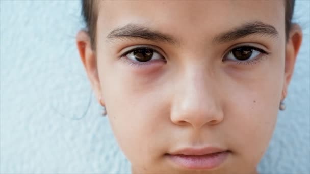Child Eye Inflamed Selective Focus Kid — Stockvideo
