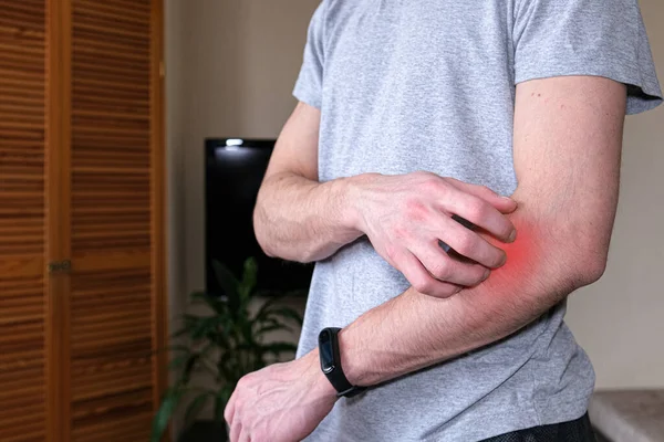 Een man die een jeukende hand krabt. Dermatitis, eczeem, allergieën, psoriasis. Close-up van een man met jeukende uitslag op zijn arm, het getroffen gebied is gemarkeerd in rood — Stockfoto