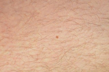 Köstebek cilt üzerinde