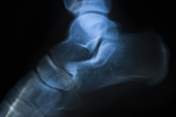 X-Ray Image form Bones in Detail — Stock Photo, Image