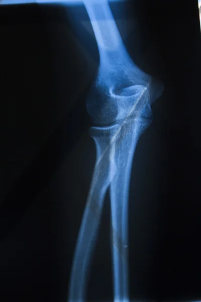 X 射线图像中的骨头 — 图库照片