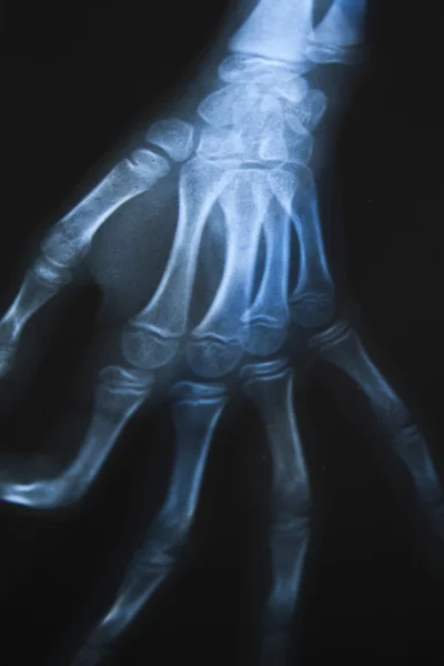 X 射线手骨 — 图库照片