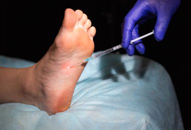 Hiperhidroz 'a karşı bir iğne kadın bir hastanın tabanında terliyor, yakın plan, rahatsızlık verici.