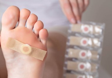 Kadın ayağı ve plantar siğili için yapıştırıcı sıva. Ayaklarda nasır ve siğil tedavisi, dermatolojik...