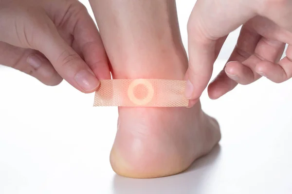 女性は足の上でのワーツの治療のための医療用石膏を固執します — ストック写真