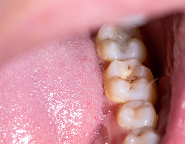 咬着牙咬着嘴上的蛀牙 安装高质量的牙科填充物 现代牙科学中的牙科治疗 — 图库照片