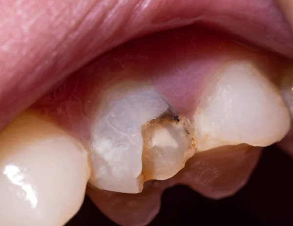 A black dead tooth in which a piece of tooth enamel is chipped off, a tooth chip. The concept of dental restoration in modern dentistry, macro. Orthodontic